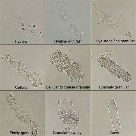 laboratory urinalysis analyzer for veterinary|non hyaline casts in urine.